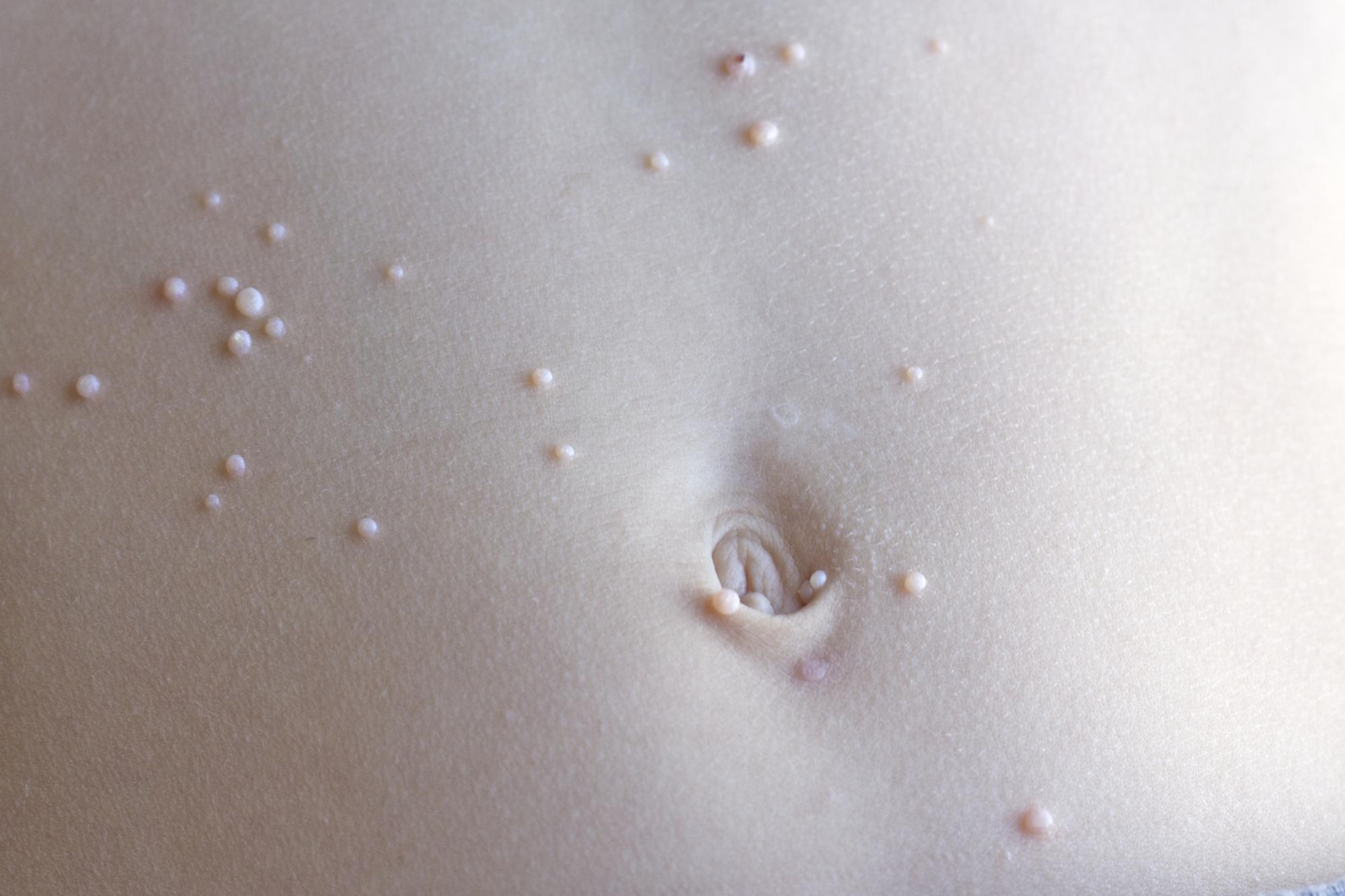 Контагиозный моллюск у детей: как контролировать инфекцию?