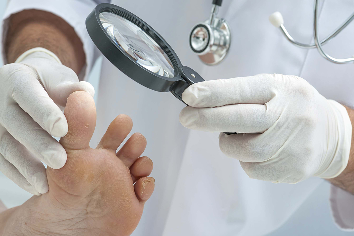 Диагностика и лечение грибка ногтей - консультация миколога